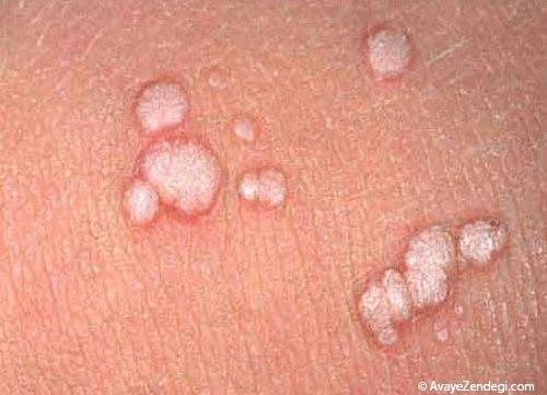عفونت های پوستی ناحیه تناسلی