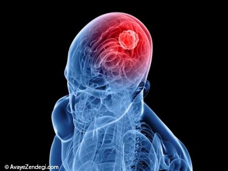 آنچه باید دربارۀ تومورهای مغزی بدانید