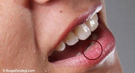  علل، علائم و راههای پیشگیری از آفت دهان 